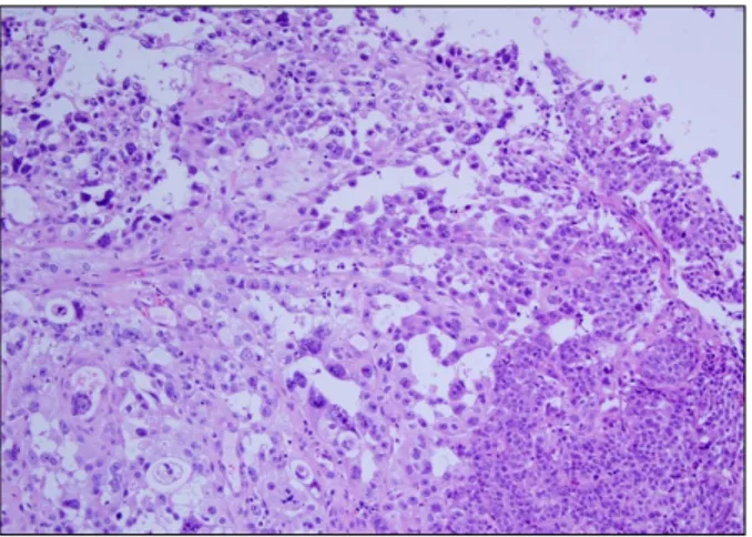 Fig. 3. Histologic findings shows moderately differentiated squa- squa-mous cell carcinoma (H&amp;E stain, ×100).