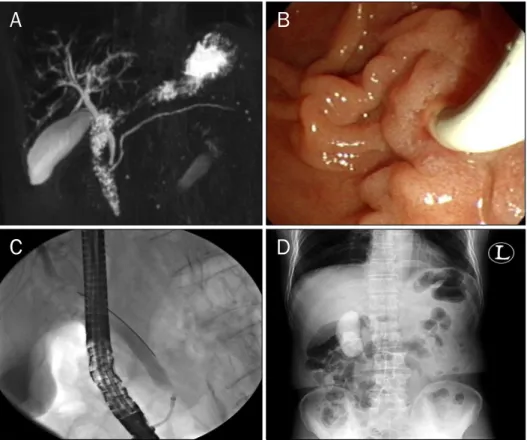 Fig. 1. (A) MRCP; normal bile duct and pancreatic duct. (B) Duodenoscopic  finding (TJF 260V; Olympus, Tokyo,  Japan); a bulging ampulla of vater