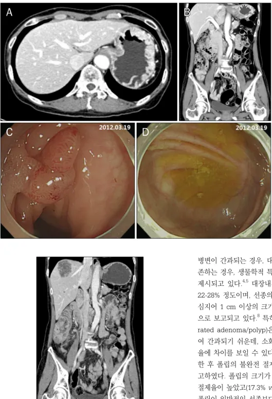 Fig. 1. Initial abdomen-pelvis CT and  endoscopic findings. (A, B) No  ab-normal findings are noted on  abdo-men-pelvis CT (A, transverse view; B,  coronal view)