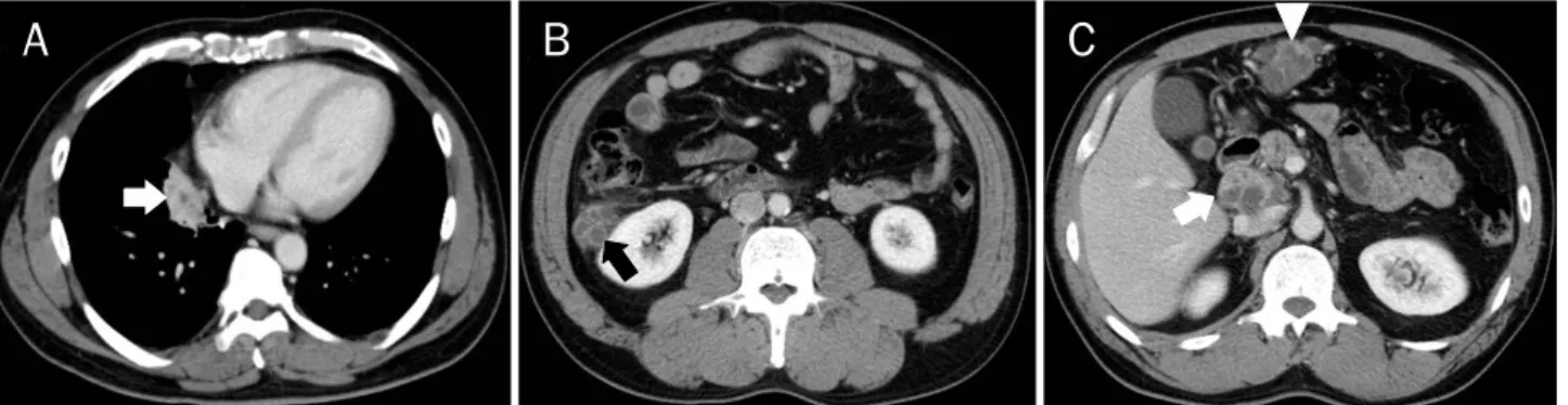 Fig. 1. CT scans of chest and abdomen at admission. (A) At medial basal segment of right lower lobe, there is a 4.0 cm sized soft tissue density  mass (arrow) harboring multifocal low attenuation areas