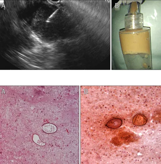 Fig. 4. Eggs of Paragonimus wester- wester-mani obtained by endoscopic  ultra-sonography-guided fine needle  aspi-ration from tissue (A) and pus (B)