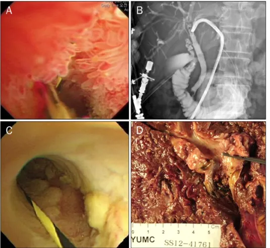 Fig. 2. (A, B) Percutaneous transhe- transhe-patic cholangioscopy before  photo-dynamic therapy (PDT) shows diffuse biliary papillomatosis from the distal common bile duct to the left  intrahe-patic duct 2nd portion