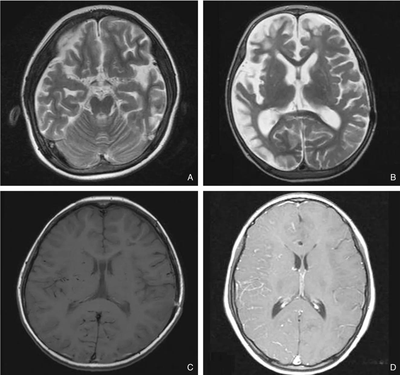 Figure 1. An axial T2 -weighted MR image shows diminished flow voids in the internal carotid and middle cerebral arteries (A) and huge cortical infarction in the right hemisphere and left frontal lobe (B)