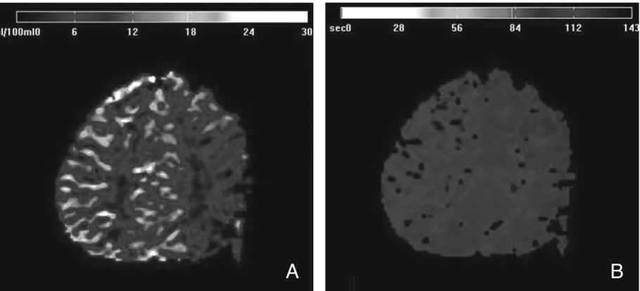 Figure 3. A perfusion MRI demonstrates an increased rCBV (A) and delayed TTP (B) in the right hemisphere.