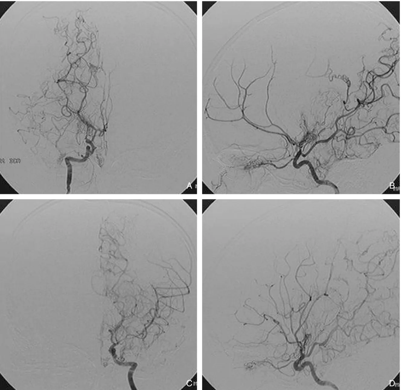Figure 4. A right carotid angiography (A: AP view, B: lateral view) shows stenotic change in the terminal portion of the internal carotid artery, total occlusion in the middle cerebral artery and stenotic change in the proximal anterior cerebral artery