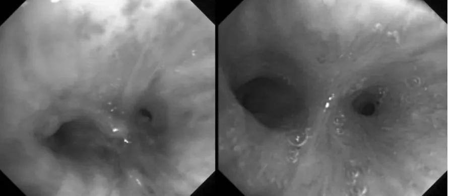 Figure 4. Double primary lung cancer at right upper lobe and lower lobe. Bronchoscopic finding shows a protruding mass at right lower lobe basal segment before photodynamic therapy(Left)