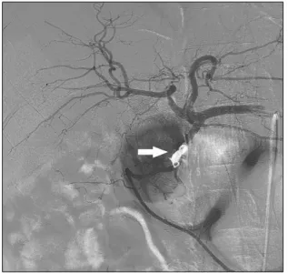 Fig. 4. Postembolization angiography demonstrates successful  embolization and cessation of blood flow into the gastroduodenal  artery aneurysm with a metallic coil (arrow).