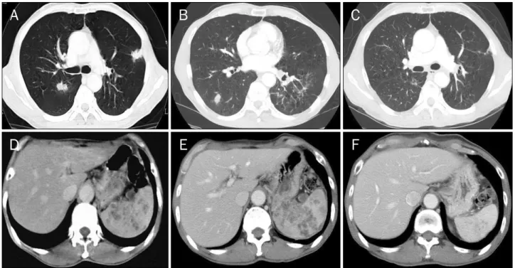 Fig. 1. CT images of chest and abdomen. (A) First chest scan shows two newly-developed 1.5-cm lobular consolidations in posterior segment  of right upper lung and anterior segment of left upper lung