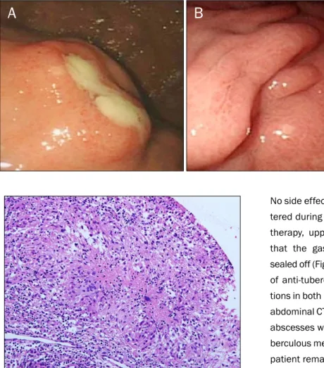 Fig. 4. Microscopic finding of spleen biopsy specimen shows well-  defined granuloma with epithelial cells and central caseous necrosis (H&amp;E, ×100)