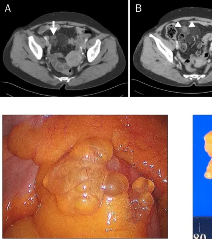 Fig. 1. Abdominal CT findings. (A) Initial CT shows 1.3 cm sized soft tissue  mass (arrow) in small bowel  mesen-tery