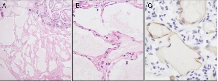 Fig. 4. Microscopic findings. (A) There are many dilated lymphatic vessels lined by a single layer of endothelium (H&amp;E, ×40)
