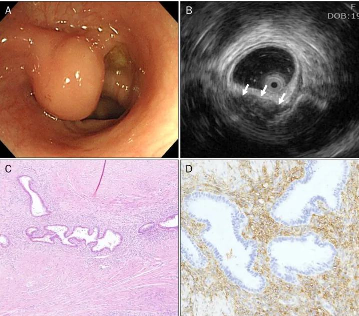 Fig. 2. (A) Endoscopic finding shows 20 mm sized protruding lesion with normal mucosa on sigmoid colon