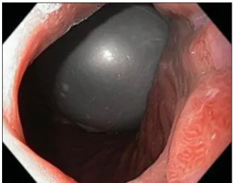 Fig. 1. Endoscopic view after placement of the intragastric balloon.