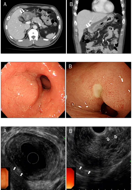 Fig. 1. Initial abdomen CT (A, trans- trans-verse view; B, coronal view). (A) The  pancreas is slightly edematous without definite evidence of inflammations