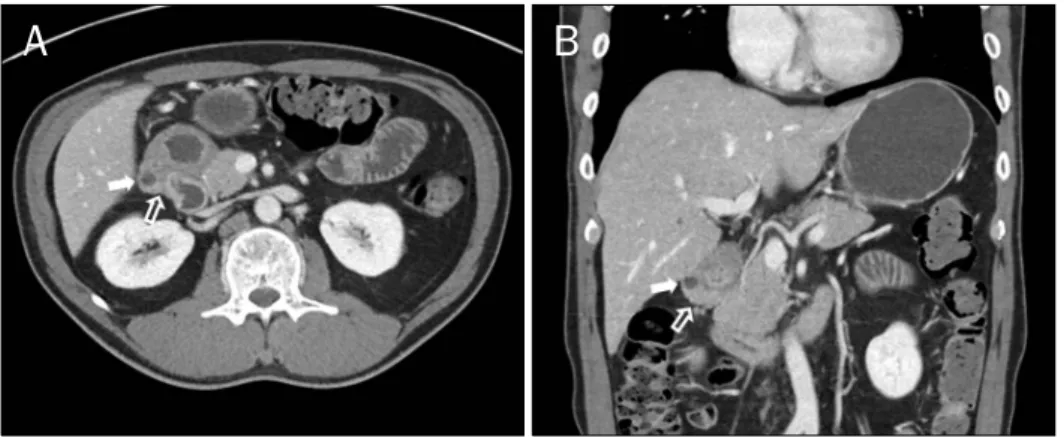 Fig. 4. Follow-up stomach CT per- per-formed 8 months later (A, transverse view; B, coronal view)