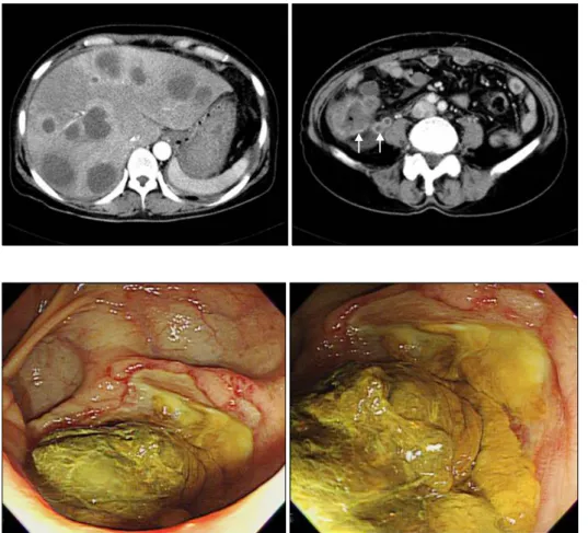 Fig. 2. Two views of a large cecal ulcer  occupying approximately two-thirds of the cecum with overlying necrotic  tissue found on colonoscopy.