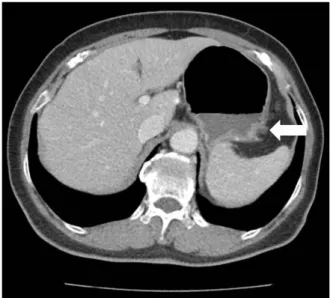 Fig. 4. Abdominal computed tomography after 5 weeks. It shows  resolution of the previous peri-gastric fluid collection (arrow).