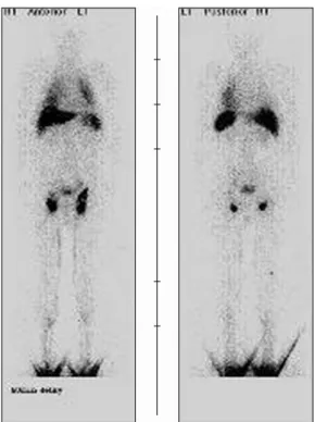 Fig. 4. Enteroscopic findings. (A) Round elevated lesion with whitish paches. 