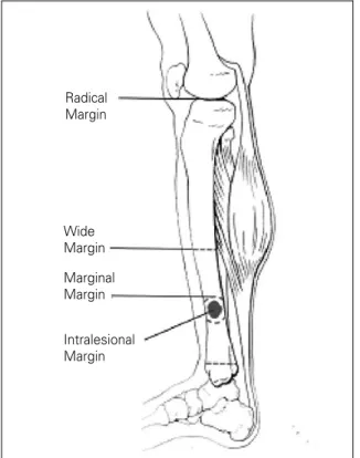 Figure 4. Osteoid soteoma(CT)