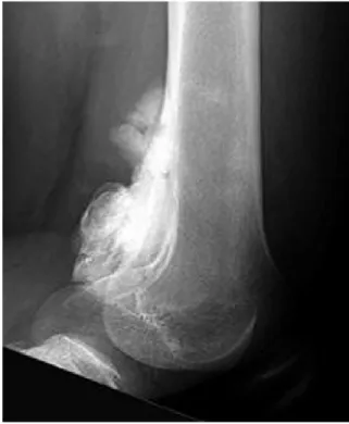Figure 5. Conventional osteosarcoma