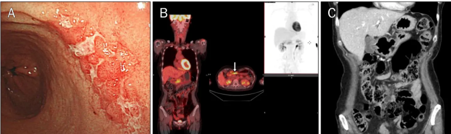 Fig. 2. This case shows the fluorine-18 fluorodeoxyglucose (F-18 FDG) uptake in an erosive-ulcerative type of gastric mucosa-associated  lymphoid tissue lymphoma