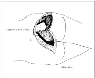 Figure 7. Harvest of superior gluteal flap based on superior gluteal artery (14)
