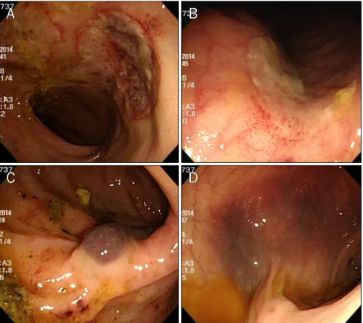 Fig. 3. Multiple large irregular shaped ulcerations are present on transverse colon. In addition, multiple  subepi-thelial hemorrhages are observed on  transverse and descending colon.