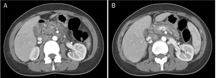 Fig. 1. Abdominopelvic CT images at the initial presentation. (A) CT image showing dilated pancreatic duct (PD) at the head portion of pancreas  with atrophic parenchyme and peri-pancreatic inflammatory change