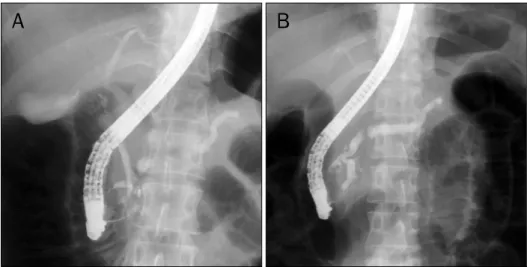 Fig. 4. Follow-up (ERCP). (A) Cholan- Cholan-giopapncreatography showing dorsal  pancreatic duct crossing over the  common bile duct