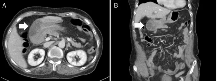Fig. 1. Initial abdominal CT findings. Axial (A) and coronary (B) view of abdominal CT shows a 3.8 cm sized mass arising from the proximal body