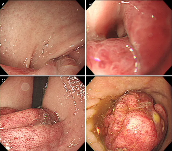 Fig. 2. Esophago-gastro-duodenoscopic findings. (A) There is deformity and stenosis in the proximal body of stomach