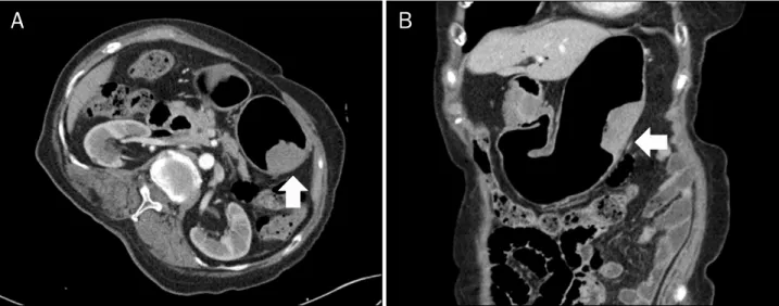 Fig. 3. Three-dimensional abdominal CT findings. Axial (A) and coronal (B) view of abdominal CT shows 5.2×2.2 cm sized mural mass at great curvature of proximal body of stomach (arrows)