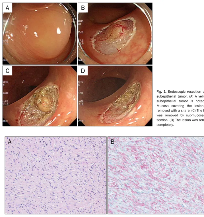 Fig. 2. Histopathologic finding of the resected tissue. (A) Bundles of spindle cells with elongated and wavy nuclei are noted (H&amp;E, ×200)