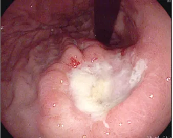 Fig. 2. Pathologic findings (H&amp;E). (A) The biopsy of stomach shows cellular infiltration with poorly differentiated adenocarcinoma, bizarre/ 