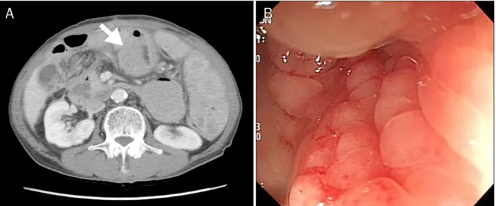Fig. 3. Colonoscopic finding. Raised erosion (0.5 cm) is revealed in the mid descending colon.