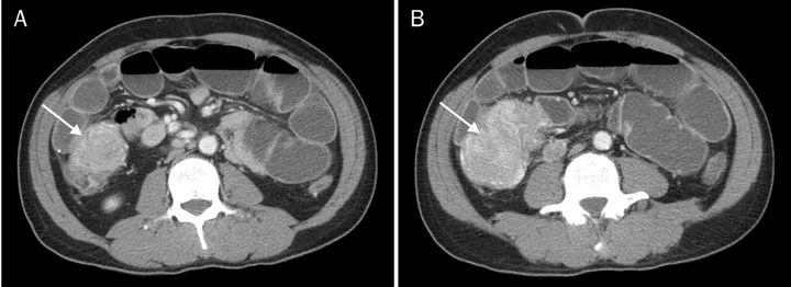 Fig. 2. A huge, obstructive mass of the ascending colon was found upon  colonoscopy. The mass was a fragile  exophytic tumor