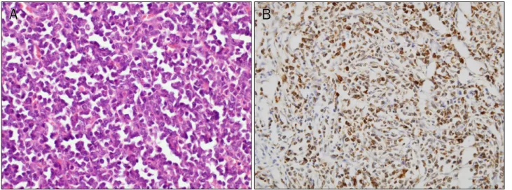 Fig. 3. Histology revealed myeloid sarcoma involving the colon. (A) Neoblastic cells have dispersed chromatin and inconspicuous nucleoli with  an indented nuclear configuration (H&amp;E, ×400)