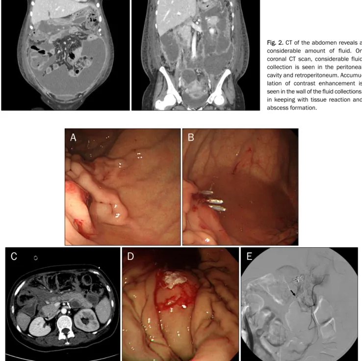 Fig. 2. CT of the abdomen reveals a  considerable amount of fluid. On  coronal CT scan, considerable fluid  collection is seen in the peritoneal  cavity and retroperitoneum