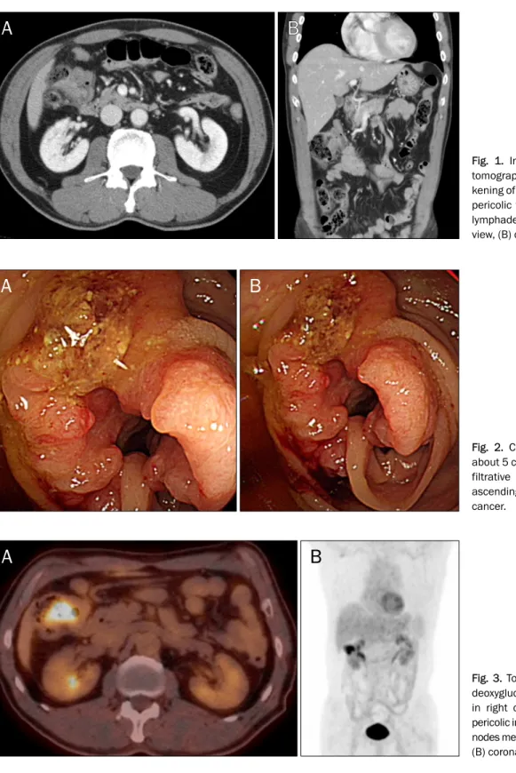 Fig. 1. Initial abdominal computed  tomography shows segmental  thic-kening of distal ascending colon with  pericolic fat infiltration and regional  lymphadenopathy