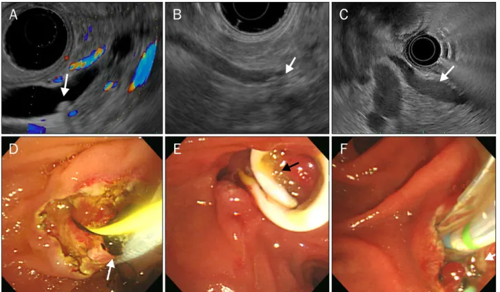 Fig. 1. Endosonographic and endoscopic findings of choledocholithiasis. Endosonography revealed the presence of hyperechoic foci in the  common bile duct; posterior shadowing (arrows) indicated choledocholithiasis (A, B), and amorphous materials in the com