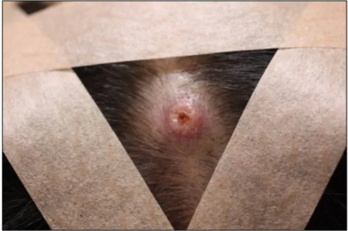 Fig. 1. Erythematous plaque with a central plug is seen on the scalp.