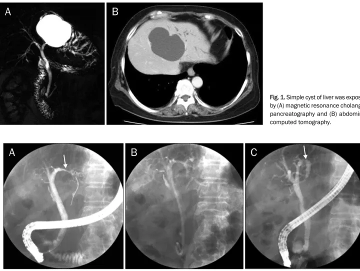 Fig. 1. Simple cyst of liver was exposed by (A) magnetic resonance  cholangio-pancreatography and (B) abdominal  computed tomography.