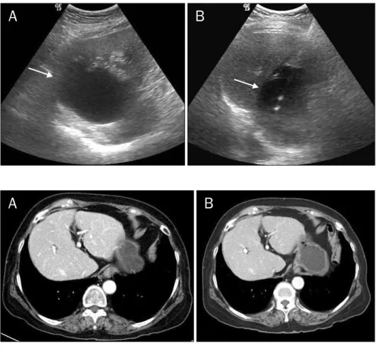 Fig. 3. Abdominal ultrasonography  revealed simple cyst of liver. (A) Before treatment (arrow)