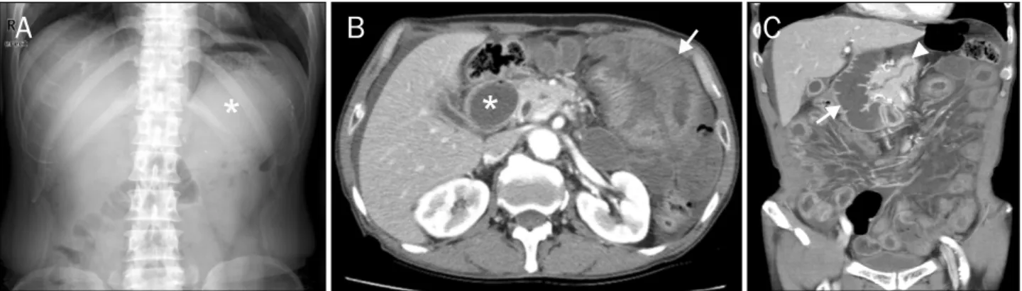 Fig. 1. Plain abdomen and abdominal CT images of Case 1. (A) Suspicious distended stomach filled with fluid (asterisk) without abnormal bowel gas