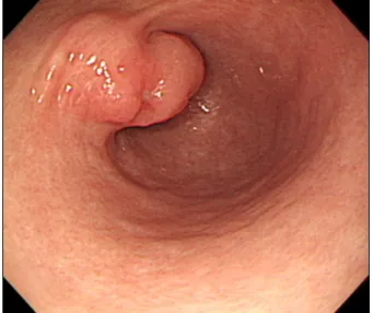Fig. 1. Endoscopic finding. A 2×3 cm sized subepithelial lesion at the anterior wall of the distal antrum.