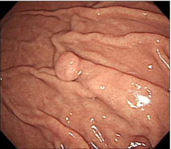 Fig. 4. Endoscopic finding. A 0.8 cm sized subepithelial lesion at the greater curvature of the fundus.