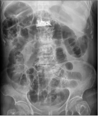 Fig. 1. Plain abdominal X-ray reveal multiple linear intraluminal gas  shadow along small bowel.