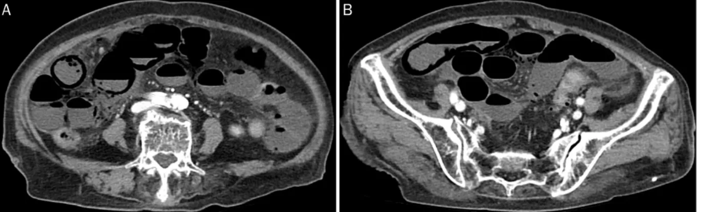 Fig. 2. (A, B) Contrast enhanced CT scan shows intramural linear gas-like pneumatosis intestinalis and intramesenteric gas in the small bowel.