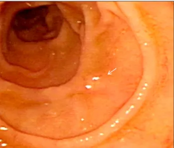 Fig. 4. Pathologic findings after endoscopic submucosal dissection of a gastric neuroendocrine tumor invading the submucosa and mucosa