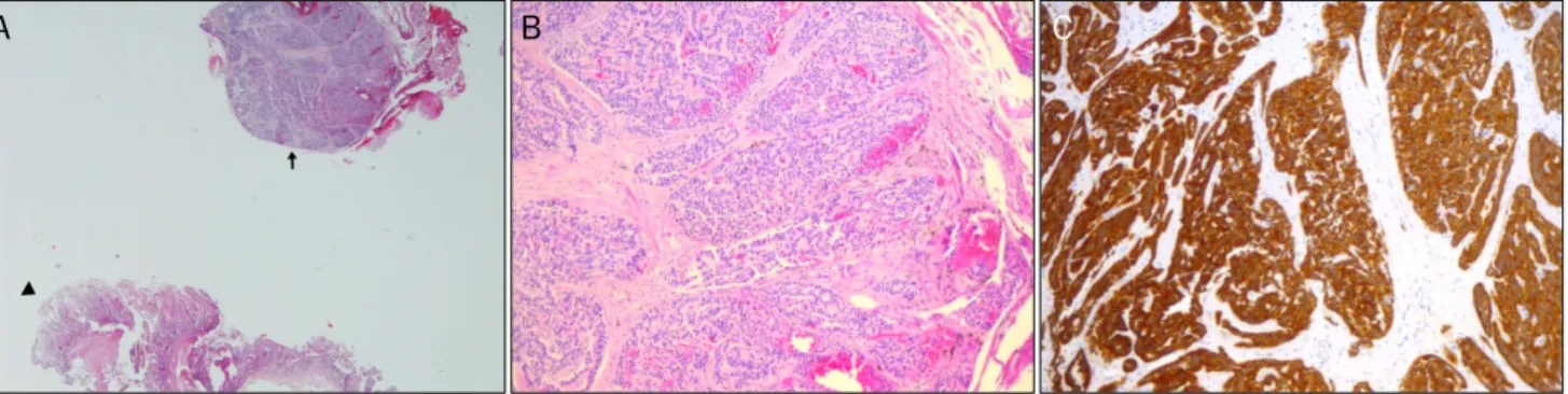 Fig. 5. Pathologic findings for an endoscopically-resected mucosal specimen containing a duodenal neuroendocrine tumor